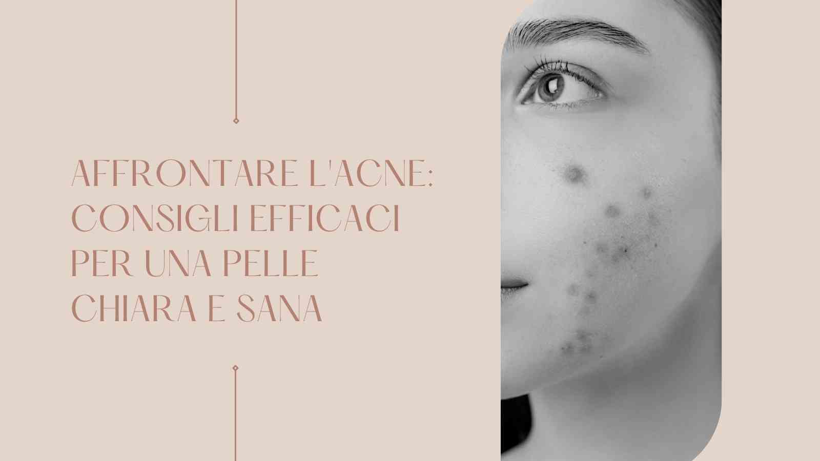 Immagine relativa al post intitolato Affrontare l'Acne: Consigli Efficaci per una Pelle Chiara e Sana 